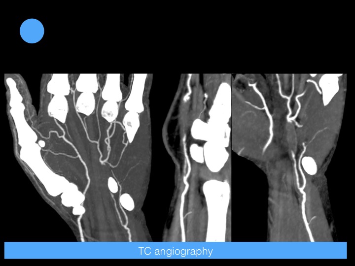 Figure 4 for case Hypothenar Hammer Syndrome